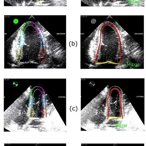 2d echo with cfds|A hybrid echocardiography‐CFD framework for ventricular flow .